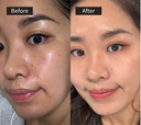 Lip Injection - before and after