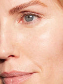 Botox Under Eyes