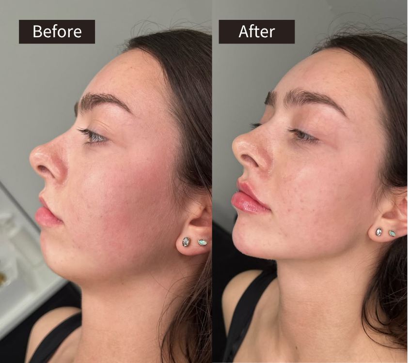 Lip Fillers - before and after