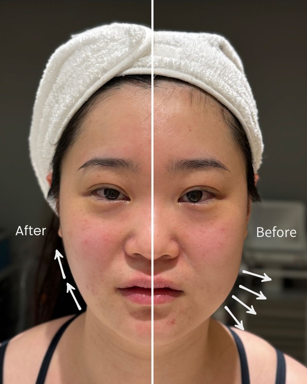 HIFU Skin Tightening in Sydney – Why Choose V Beauty Skin Clinics