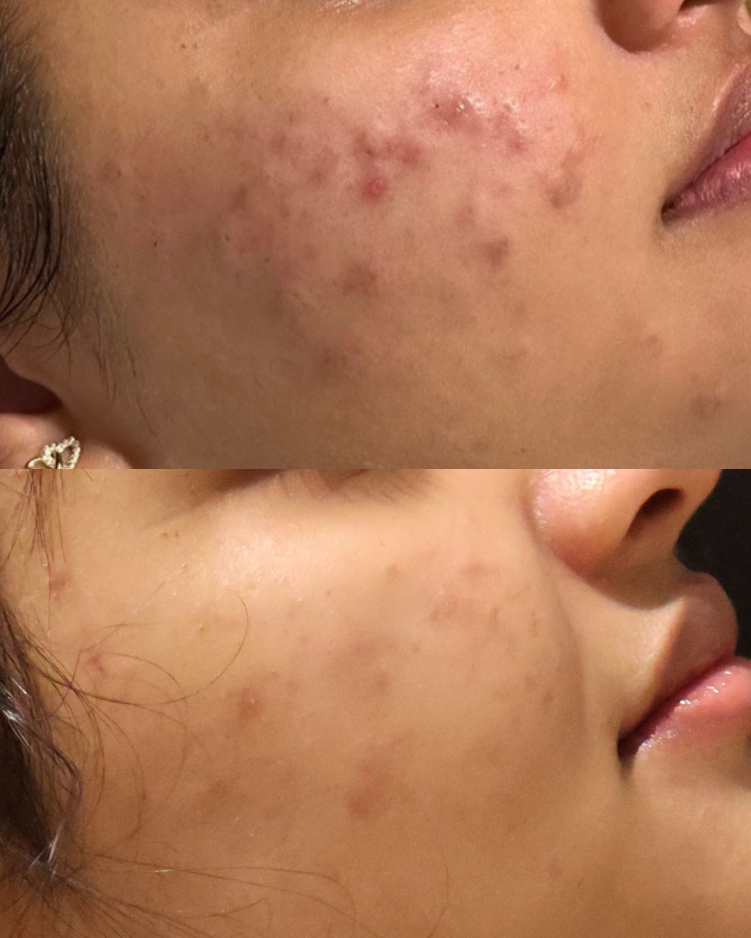 Rejuran Before & After: What Sydney Clients at V Beauty Skin Clinics Are Seeing