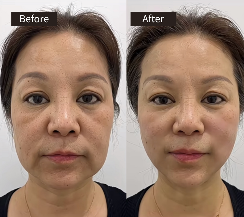 Side-by-side photos of a woman’s face labeled Before and After, showing visible facial changes such as reduced under-eye puffiness and smoother, brighter skin in the After image.