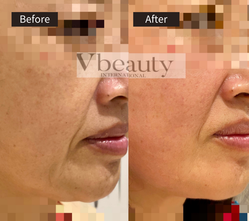 Side-by-side comparison of a womans lower face before and after a skincare treatment, showing reduced wrinkles and smoother skin; both faces are pixelated, and Vbeauty is written across the center.
