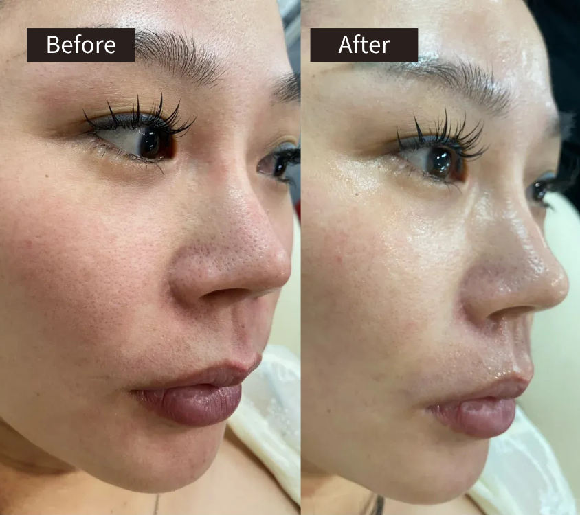 Side-by-side close-up of a womans face labeled Before and After, showing smoother, brighter skin with reduced redness and smaller pores in the After image.