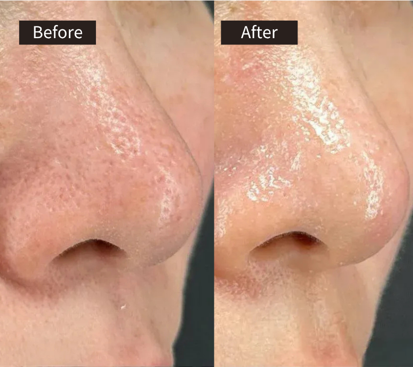 Close-up comparison of a nose before and after skincare treatment; the before side shows visible pores and uneven texture, while the after side appears smoother and more radiant.