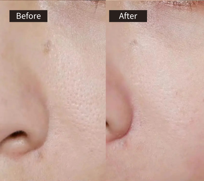 Side-by-side close-up of a cheek and nose area labeled Before and After. The Before side shows visible pores and uneven texture, while the After side appears smoother with reduced pore visibility.
