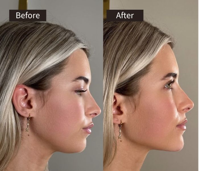 Side-by-side profile photos of a woman labeled Before and After, showing a subtle change in her jawline and chin; her hair and earrings remain the same in both images.