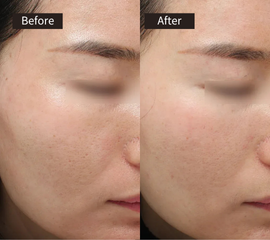 Side-by-side close-up of a persons cheek labeled Before and After. The After image shows smoother and clearer skin with reduced redness and pores compared to the Before image.