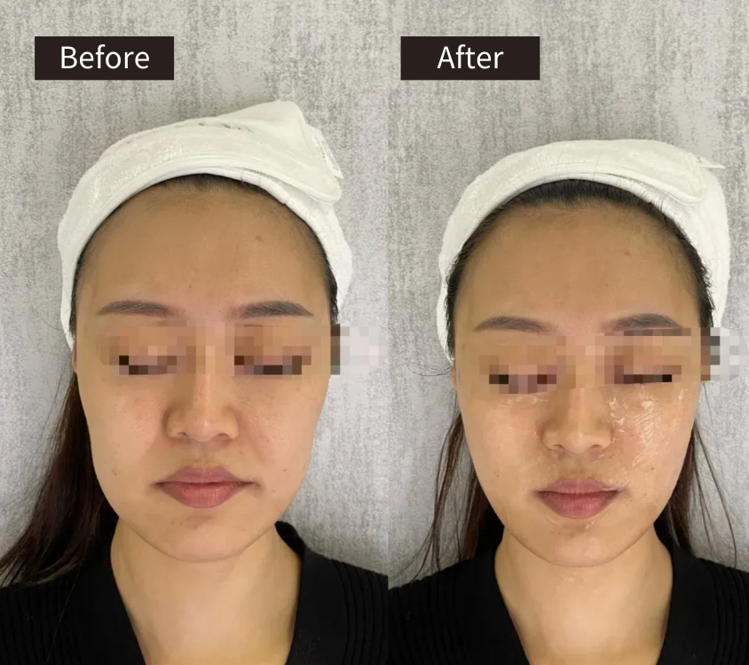 Side-by-side photos of a woman with eyes closed and a white headband, labeled Before and After, showing subtle facial changes, possibly after a skincare or beauty treatment.