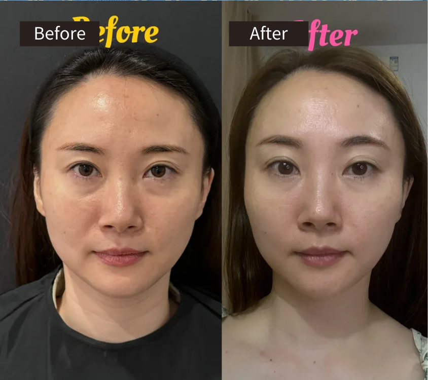 Side-by-side photos of a woman’s face showing a Before image on the left and an After image on the right, highlighting subtle changes in skin texture and facial appearance.