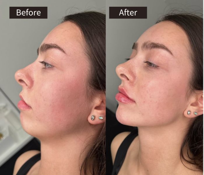 Side-by-side photos of a woman’s face labeled Before and After, showing improvements in skin texture and tone; redness and blemishes appear reduced in the After image.