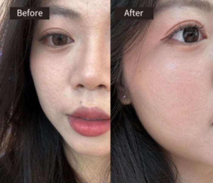 Split image showing a close-up of a woman’s face. The left side, labeled Before, shows visible pores and uneven skin texture. The right side, labeled After, shows smooth, even-toned, and clearer skin.