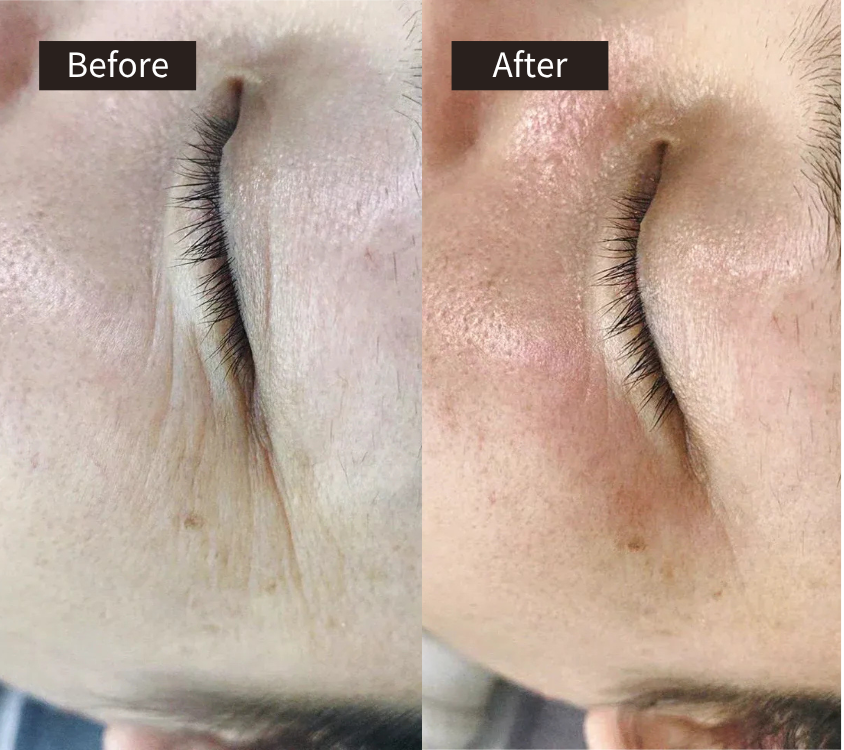 Side-by-side close-up images of a persons closed eye area labeled Before and After; the Before shows visible lines under the eye, while the After shows smoother, less wrinkled skin.