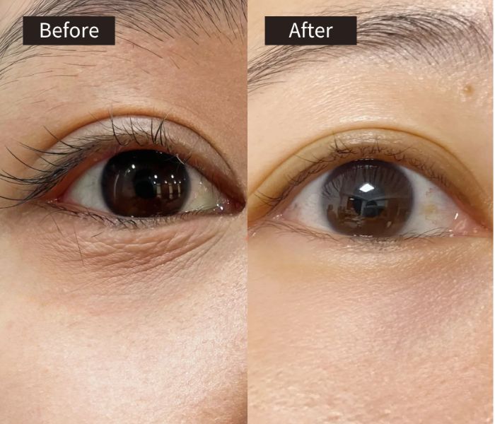 Close-up of an eye in two side-by-side images labeled Before and After. The Before side shows visible fine lines and wrinkles under the eye, while the After side shows smoother skin with reduced lines.