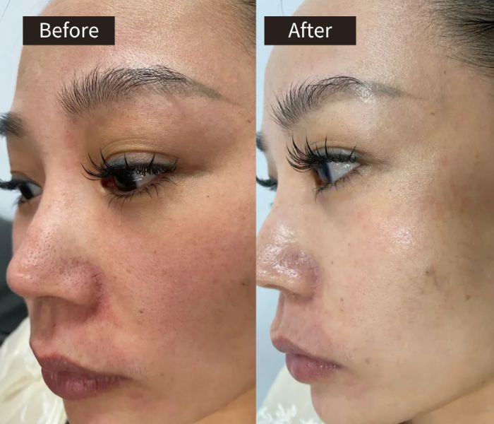 Side-by-side close-up of a womans face before and after treatment. The before image shows redness and uneven skin tone; the after image shows smoother, clearer, and more even skin.