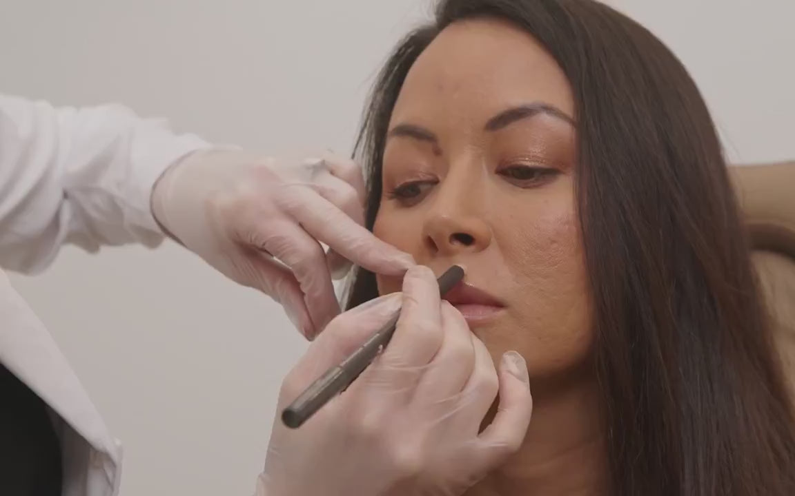 best lip filler in sydney