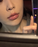 sydney lip filler best lip filler sydney